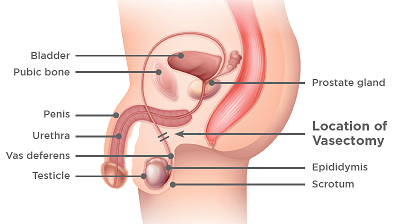 vasectomy diagram