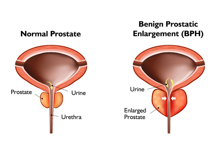 Benign Prostatic Hyperplasia Bph South Terrace Urology