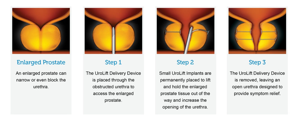 Urolift Adelaide